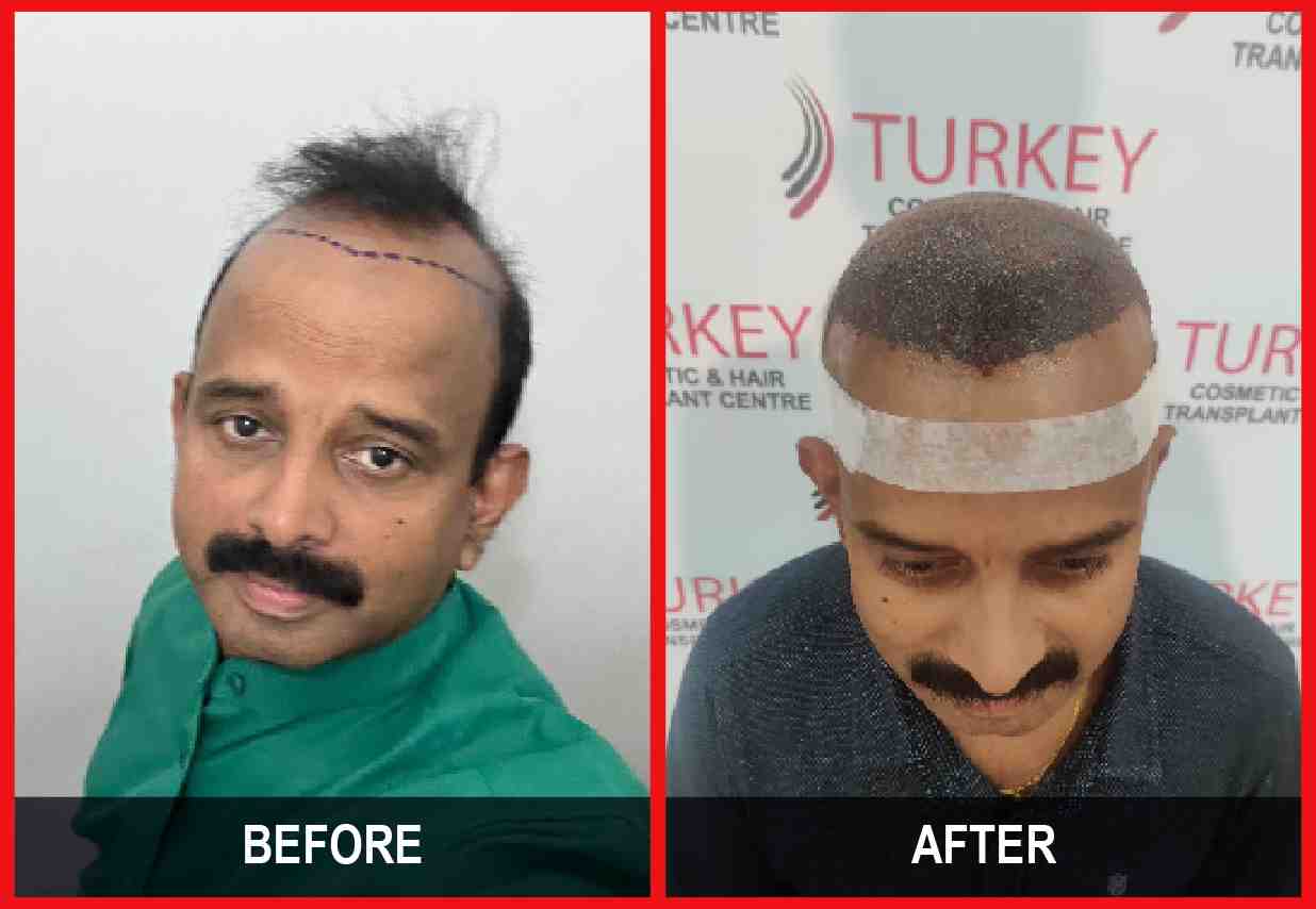 Hair Transplant Before & After Image_ 21