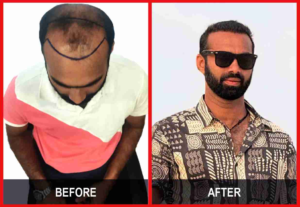 Hair Transplant Before & After Image 23